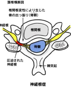 頚椎症説明図
